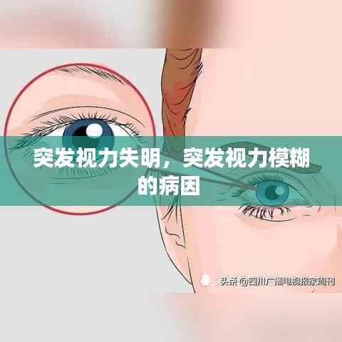 突发视力失明,突发视力模糊的病因